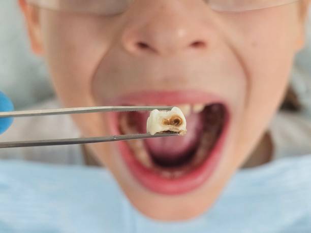 Best Emergency Gum Treatment in Cambridge, NE